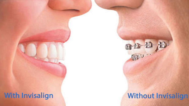 Orange CA Invisalign