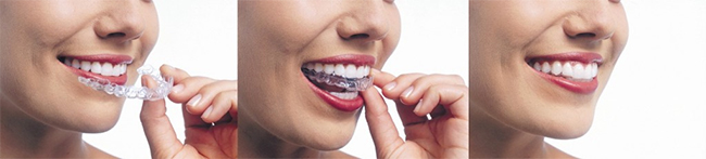 El Modena Invisalign System