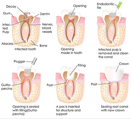 Root Canal Description